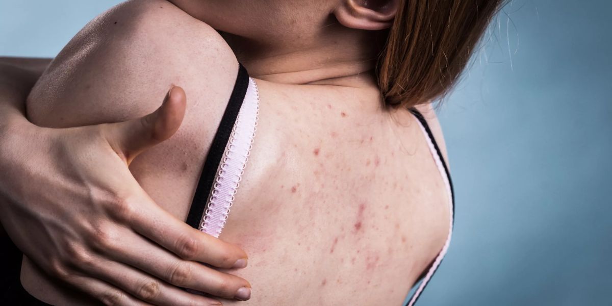 8 Skincare Ideas to Take care of Back Acne